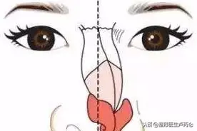 鼻子皮肤薄，医生说整形时需要真皮或筋膜是怎么回事？图片