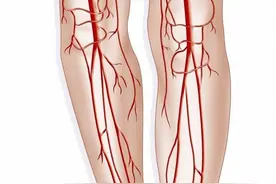 腿上的红血丝，是静脉曲张吗？图片