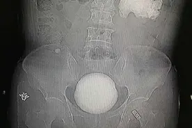 男子骨折去医院拍片，意外发现膀胱内藏巨大结石！当事人却表示不痛不痒图片