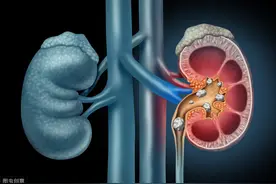 肾结石痛起来要命，怎么吃防结石？医生说清各类型结石图片