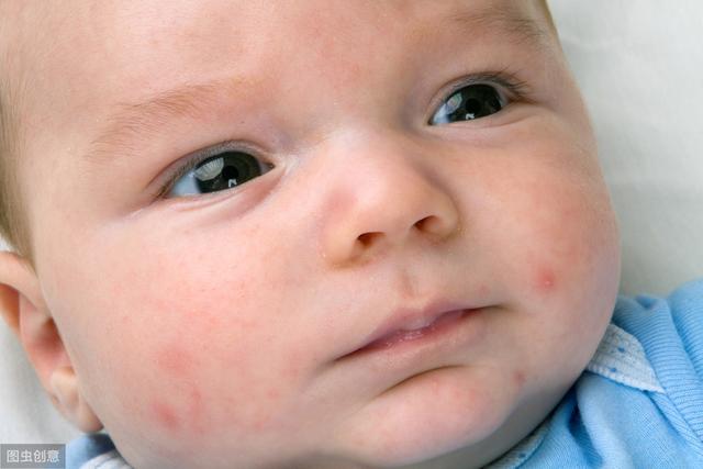 8岁女孩脸部有毛囊角化丘疹