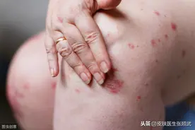 老人患银屑病_牛皮癣10年，一直使用偏方治疗，不敢告诉子女。图片