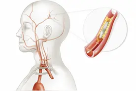 脑血栓患者的三个通病，不改正5年后偏瘫，改正后10年未复发图片