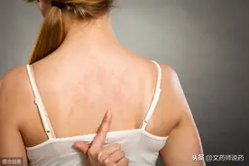 春暖花开，“风疙瘩”找上你怎么办？看看药师怎么说图片