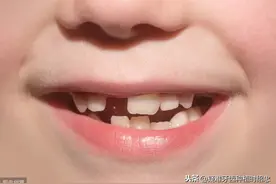 牙齿断了不处理，不仅吃啥都不香，还可能让你变丑图片