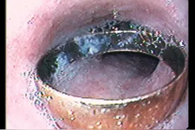 鸡骨头到底有多值钱？小小“鸡骨”引发的近5万的惨痛教训图片