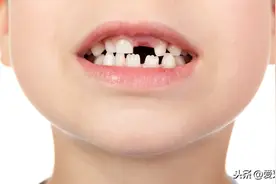 说话漏风，牙缝越来越大该怎么办？图片