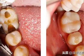牙齿矫正为什么要经历洗牙、补牙、拔牙三部曲？图片