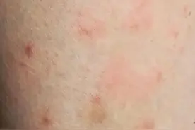 顽固性湿疹为什么难治？75岁老奶奶反复发作9个多月，最终痊愈图片