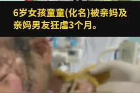 惨绝人寰！烫水浇头火烧嘴，6岁女童遭亲妈及其男友虐待险丧命图片