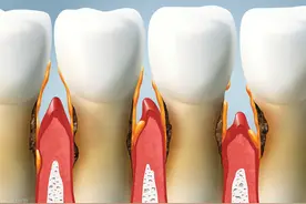 长期吃氨氯地平降血压，牙龈增生怎么办？一定要换药吗？一文说清图片