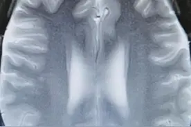 胆小勿入！男子吃生牛肉脑内生虫，想躲开寄生虫你得这样吃图片