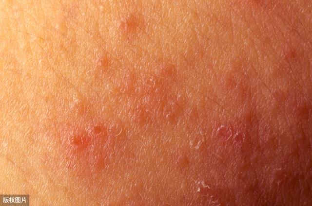 外阴鳞状上皮过度角化不全