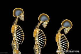 李坤明医生：驼背与寿命的关系（一）图片