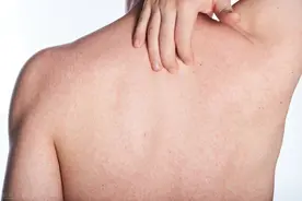 为什么背上总是长痘？原因来源于生活，看看自己中招没图片