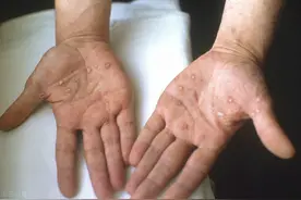 梅毒有哪些症状，梅毒有哪些传播途径，梅毒能彻底治好吗？图片