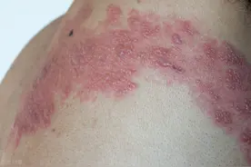 痛如刀割：带状疱疹又叫缠腰蛇，中医有这些特殊疗法，及时治疗图片