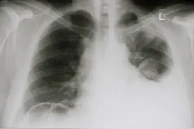 有人说肺生水就是癌，这判断太简单粗暴了，至少还有其他五种原因图片