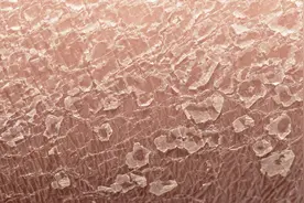 鱼鳞病，皮肤如鱼鳞一般的疾病，目前尚未能治愈图片