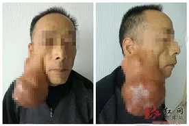 常德老汉耳下长巨型肿瘤 足球般大重达5斤图片