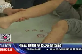 女孩脚上起了紫红色斑点，家长以为是湿疹，可送医后才发现不简单视频封面