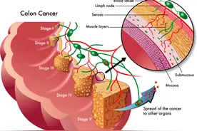 益生菌治疗结肠癌患者术后化疗相关性腹泻效果好图片