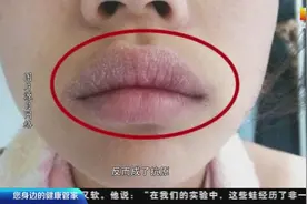 减压注意！8岁男童因压力大舔嘴，结果竟舔成“香肠嘴” 医生建议视频封面