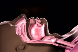 独家：家用呼吸机治疗打呼噜（鼾症）的原理视频封面