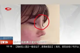 术后鼻梁突出鼓小包，女子不满意，院方解释恢复期？