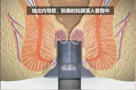 痔疮微创手术全过程，看完这个动画你就都懂了（精编字幕版）