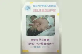 海宁15万分之一概率的连体宝宝 上海成功“分身”图片
