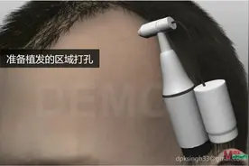 脱发（斑秃）还在困扰你？高清动画展示植发是怎么完成的视频封面