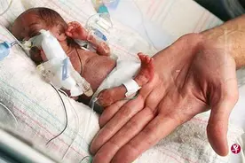 世界最轻婴儿仅0.4斤重图片