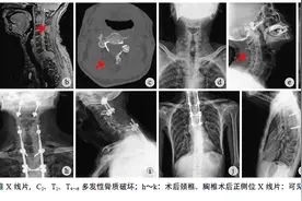 病例：脊柱多发硬化性上皮样纤维肉瘤一例图片