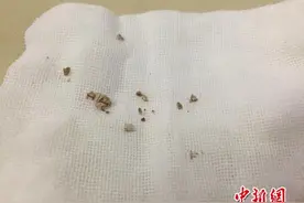 2岁男童患结石 或因吃“辣条”喝饮料导致图片