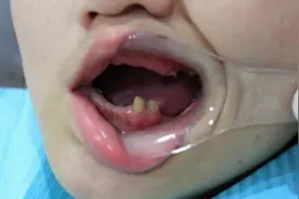 九岁孩子只剩下几颗牙齿，医生检查后，奶奶偷偷收拾行李离开家视频封面