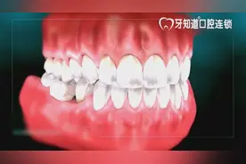 3D动画演示：单颗牙齿缺失对邻牙的伤害