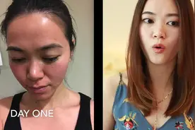 网友分享第一次医美经历：皮秒激光美白淡斑，嫩肤细致毛孔视频封面