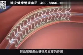 2分钟带你认识心脏可溶性支架视频封面