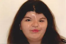 天生没有鼻子女孩完成肋骨移植修复 爱上自拍重拾自信图片