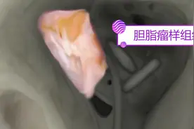 看起来很吓人的乳突根治术，非重症患者不建议做