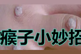 根治瘊子板蓝根就可以，不用再苦恼了视频封面