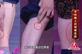 小腿上的这种斑，预示着糖尿病并发症已出现！糖友千万要注意！视频封面