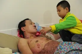 顺义小伙严重烧伤九死一生 最难的关过了我要坚持下去图片