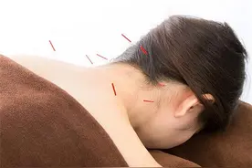 针灸如何治痛风 可针刺疗法进行调补图片