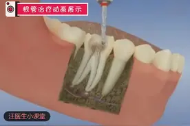 你的牙还好吧？3D动画演示根管治疗过程