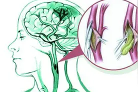 经常抽烟、饮酒更容易引起脑血管狭窄 其常见症状有这些视频封面