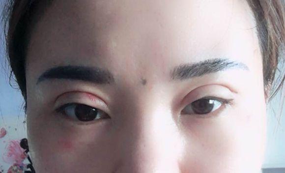心血来潮做了个埋线双眼皮,大家帮我看看是不是失败了!