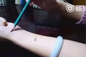十人九痔，中医治疗痔疮的2个穴位，效果显著，预后良好视频封面