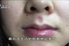 女子唇上长了个痘痘，用手挤掉后出事了，竟被送进了ICU治疗视频封面